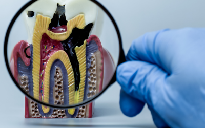 Zabieg resekcji wierzchołków korzenia